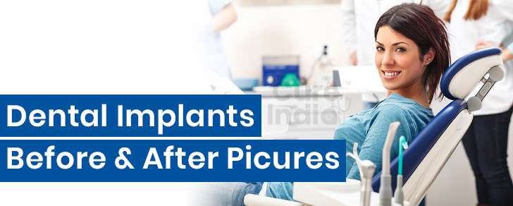 Dental Implants Before and After